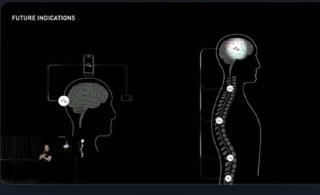 马斯克的脑机接口获批人体实验：人造人要来了？