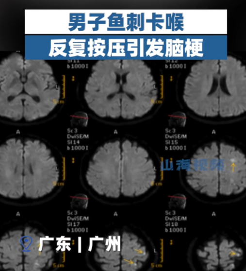 吃年夜饭鱼刺卡喉 医生一晚接诊近40例 提醒：切勿自行处理