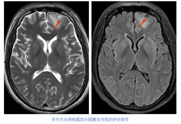 男子莫名抽搐高烧查出有虫子钻进大脑：疑喝“生水”感染脑囊虫